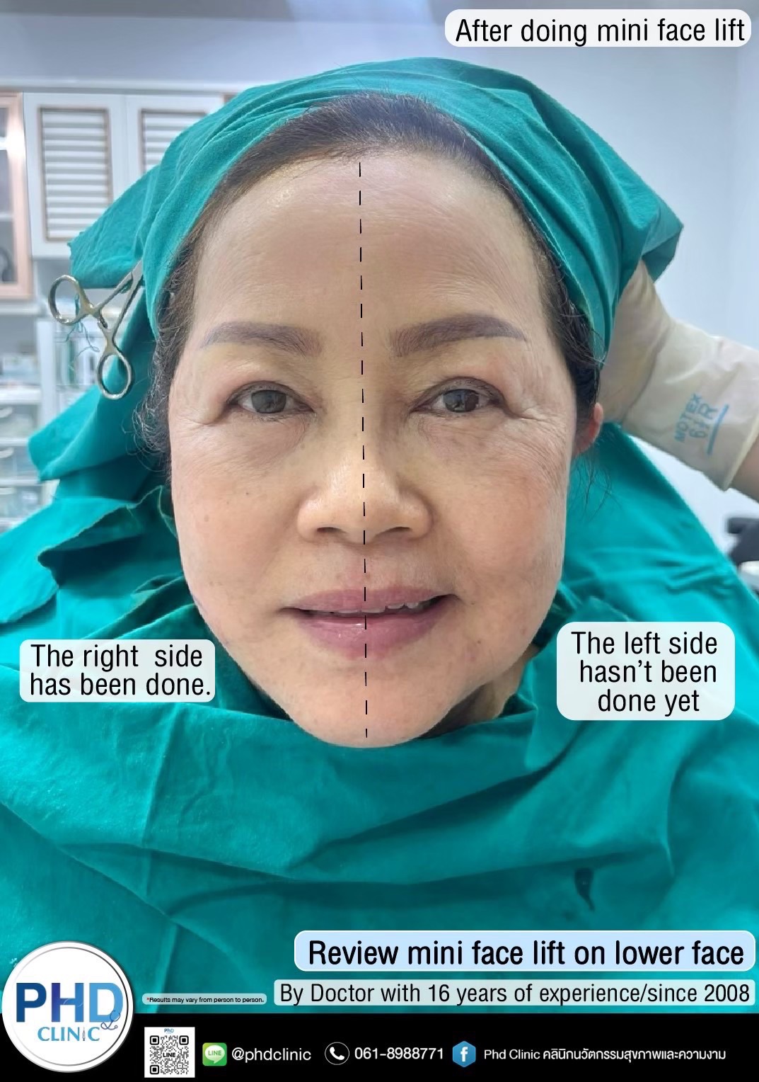 Facelift Bangkok