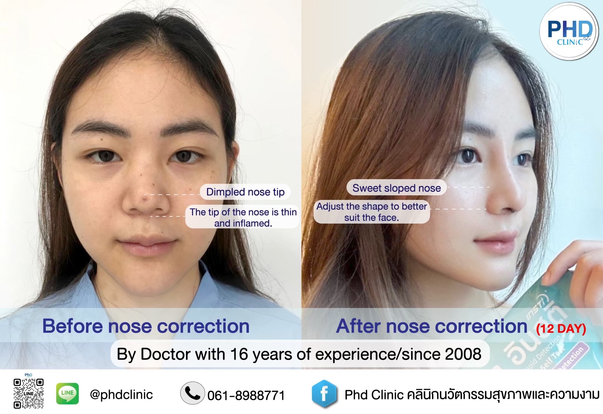 Rhinoplasty Bangkok