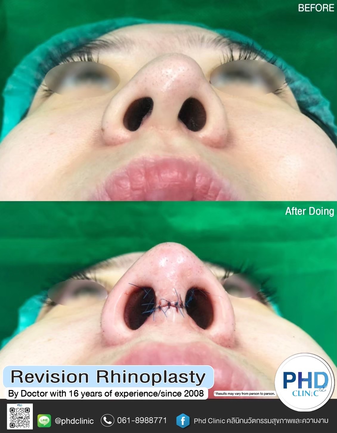 Rhinoplasty Bangkok