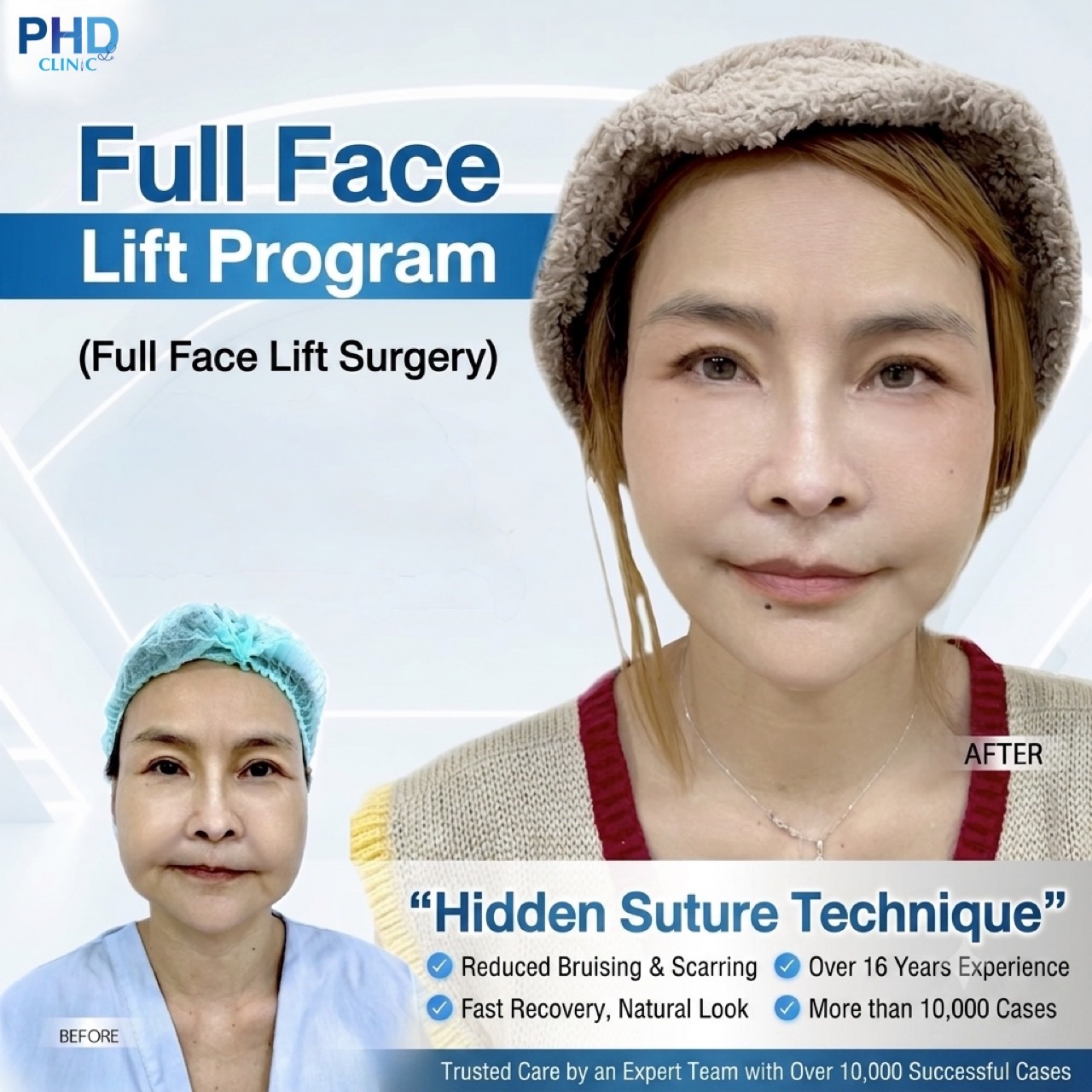 Best Facelift Clinic in Pattaya