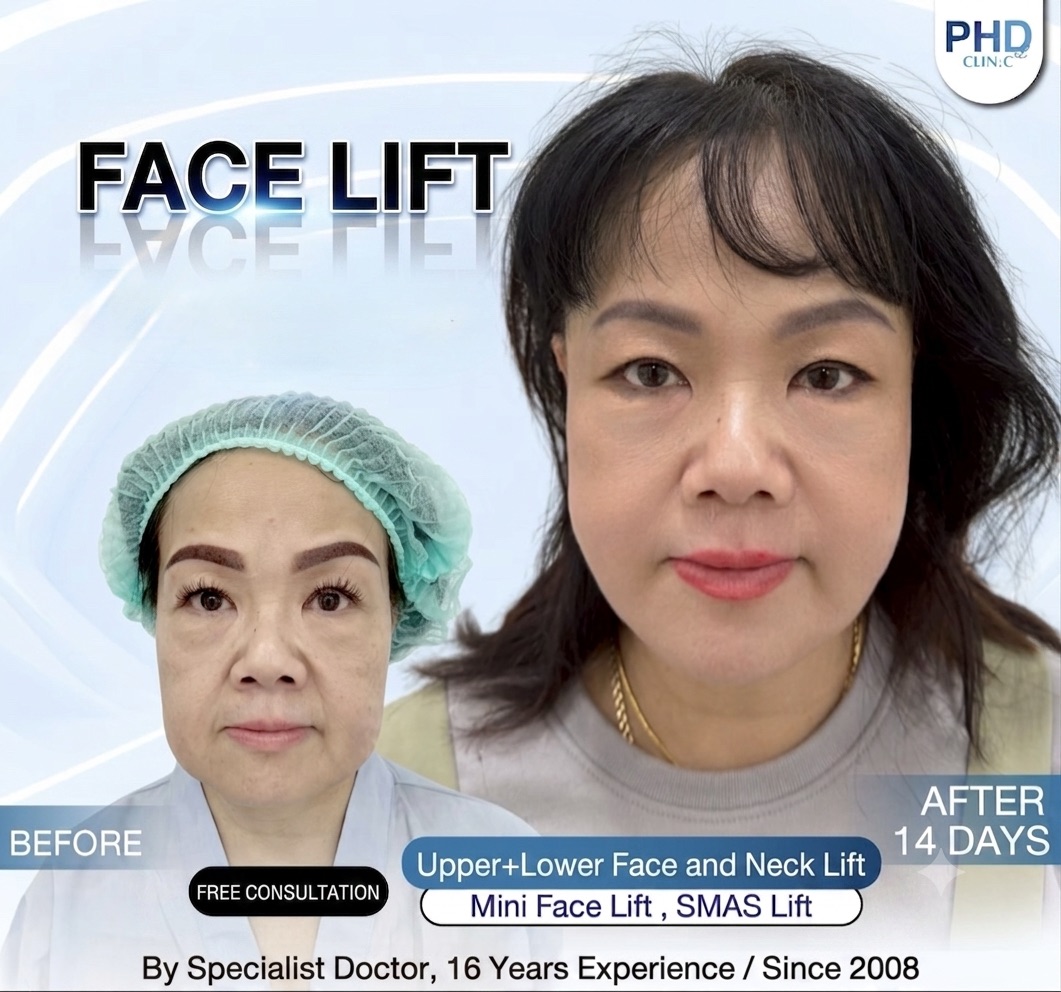 Best Facelift Clinic in Pattaya