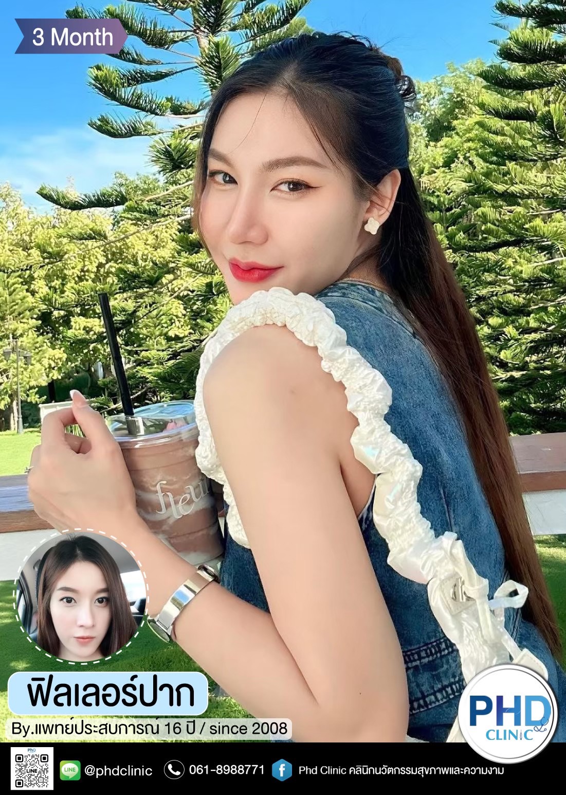 ฉีดฟิลเลอร์