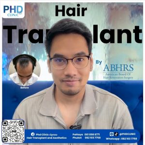 What is hair transplantation ?