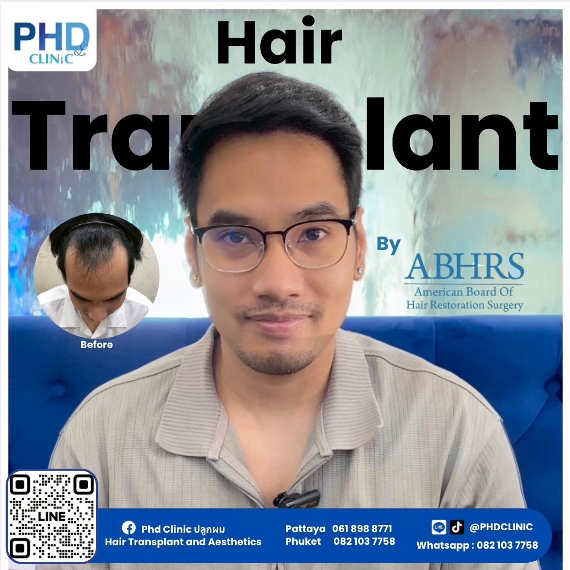 What is hair transplantation ?
