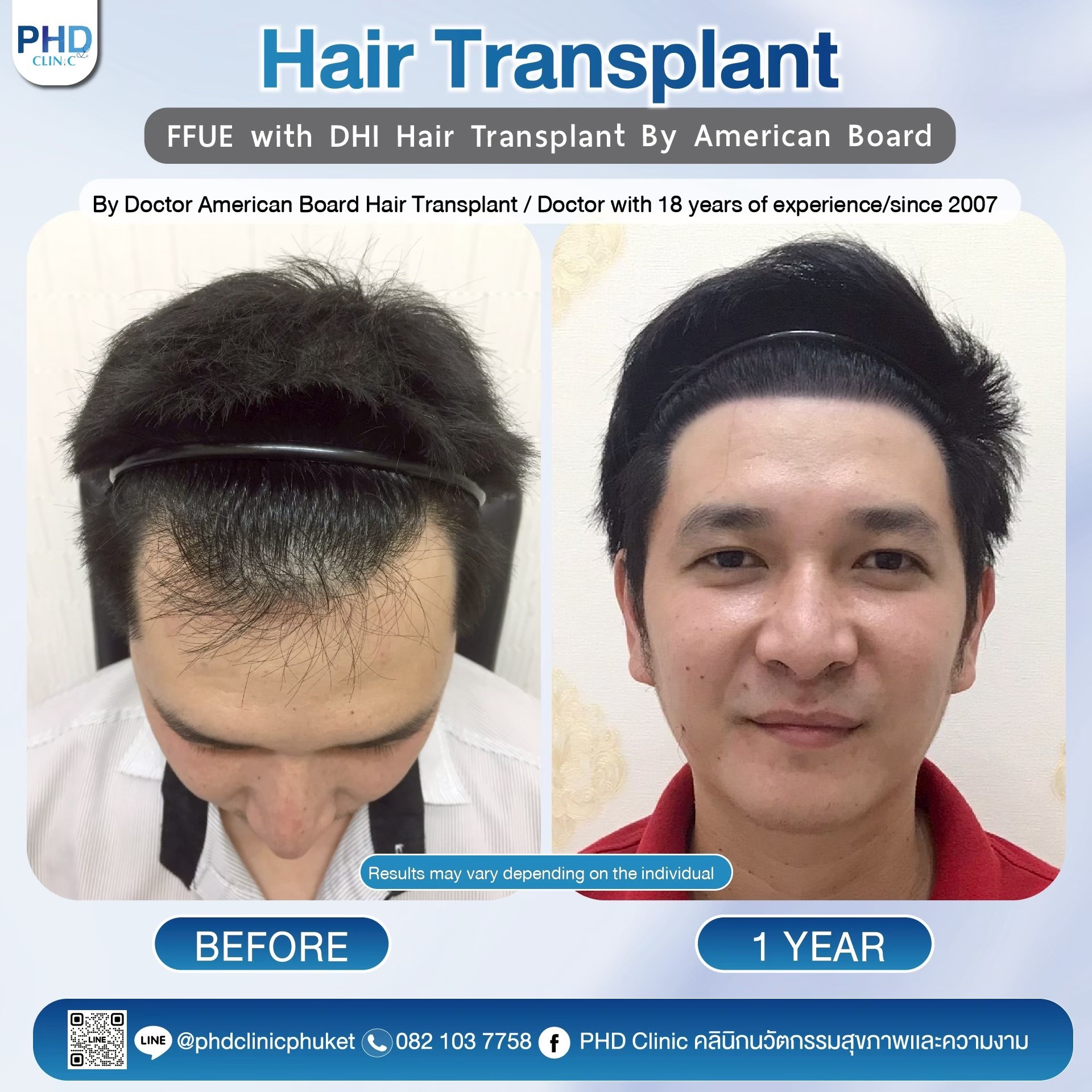 What is hair transplantation ?