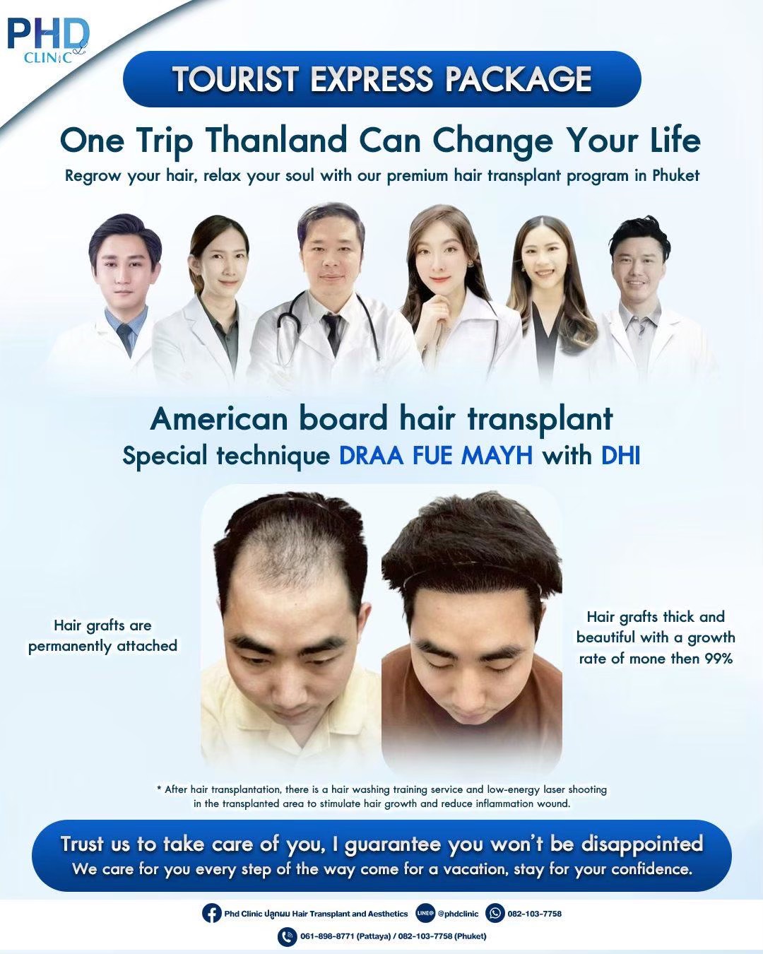 What is hair transplantation ?