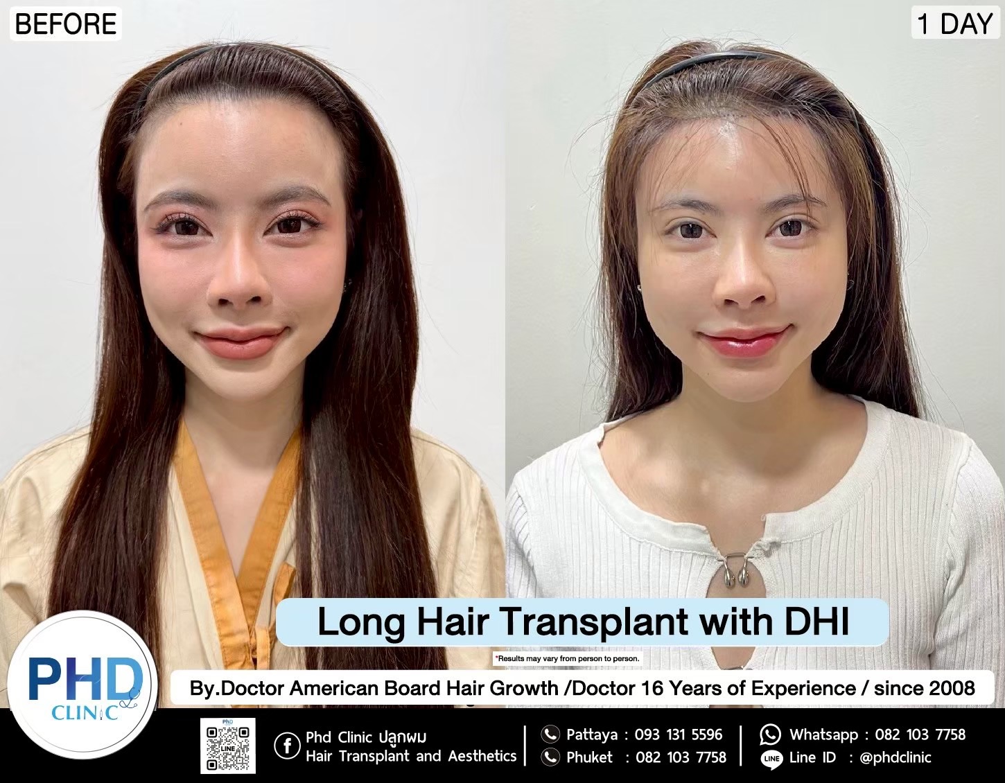 What is hair transplantation ?