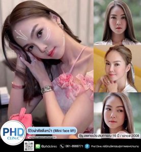 การผ่าตัดดึงหน้าต่างจากการร้อยไหมอย่างไร