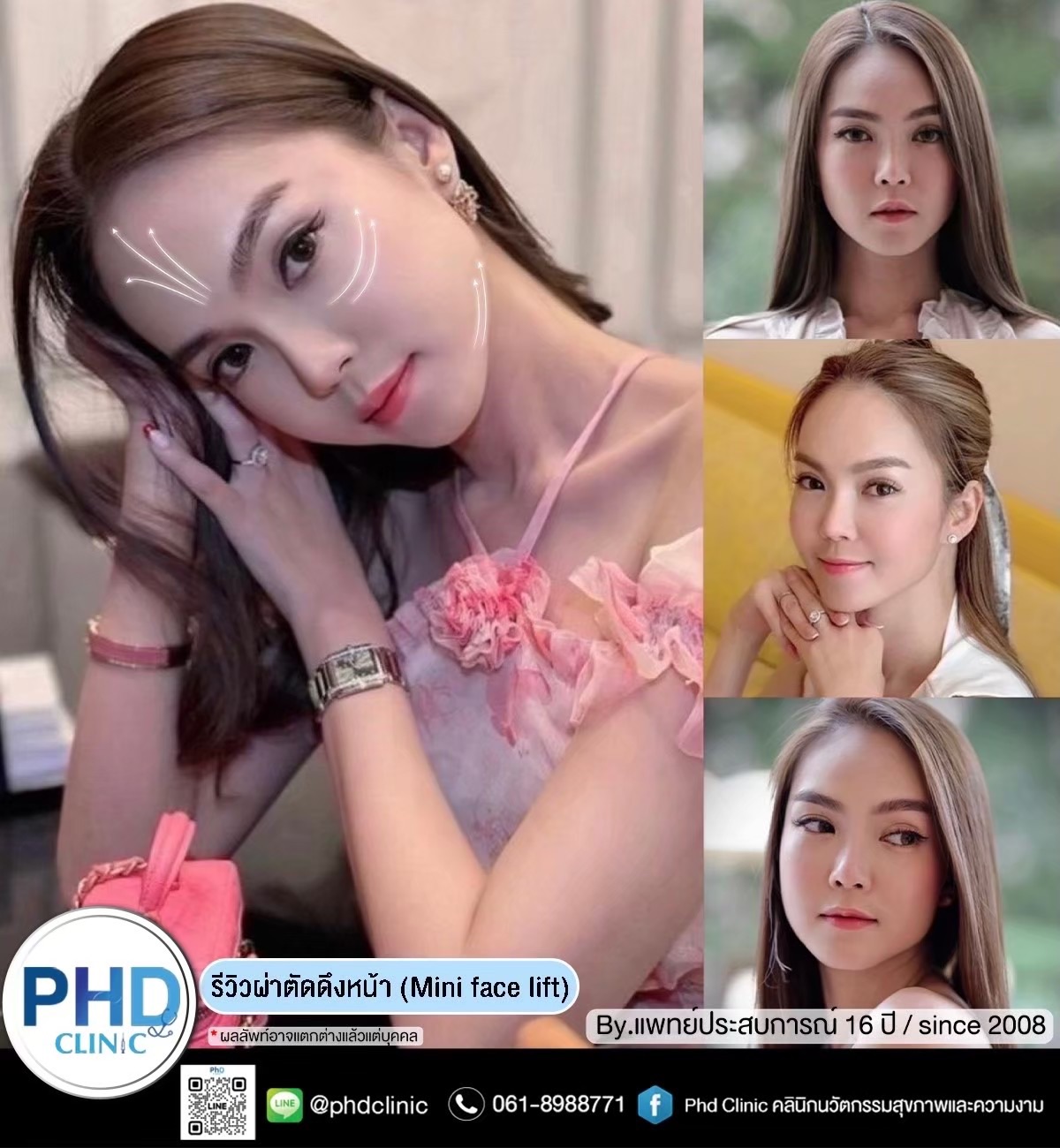 การผ่าตัดดึงหน้าต่างจากการร้อยไหมอย่างไร