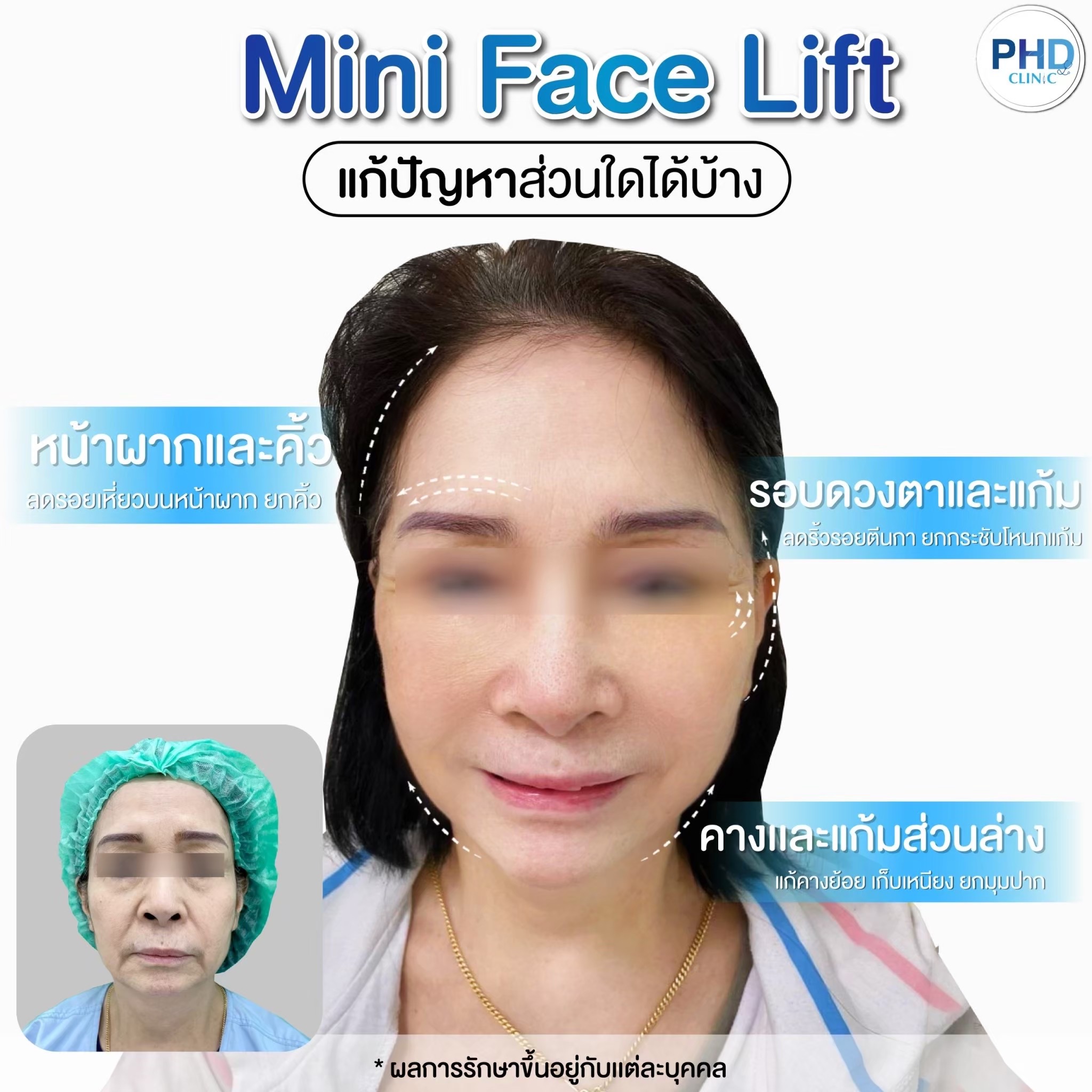 การผ่าตัดดึงหน้าต่างจากการร้อยไหมอย่างไร