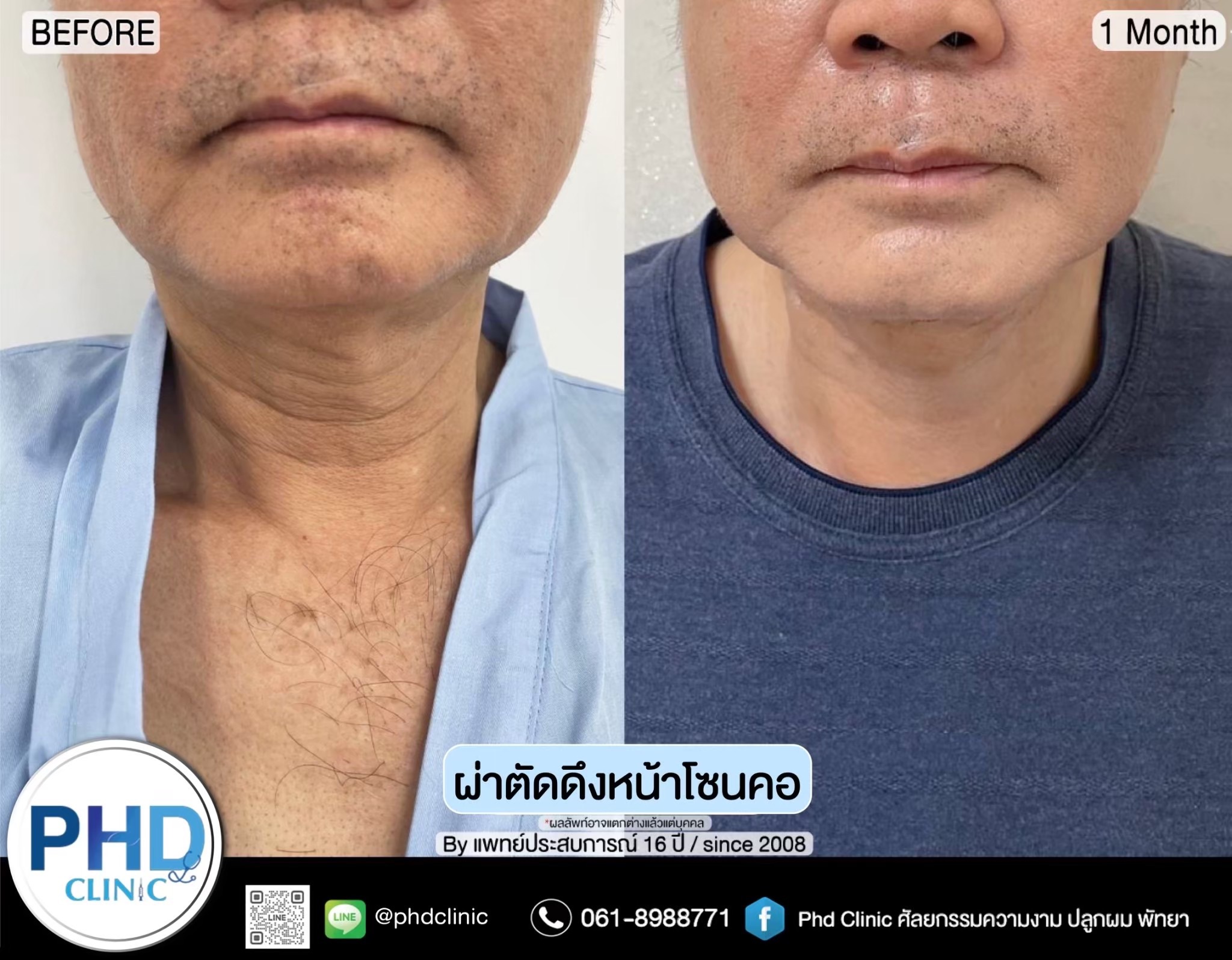 การผ่าตัดดึงหน้าต่างจากการร้อยไหมอย่างไร