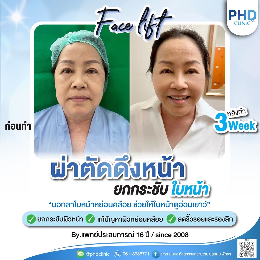 การผ่าตัดดึงหน้าต่างจากการร้อยไหมอย่างไร