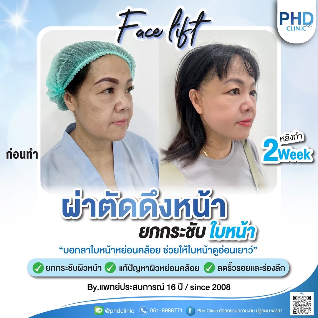 การผ่าตัดดึงหน้าต่างจากการร้อยไหมอย่างไร